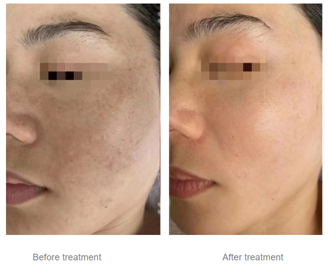 NUBWAY | Who Can Benefit Most from Picosecond Laser Therapy?