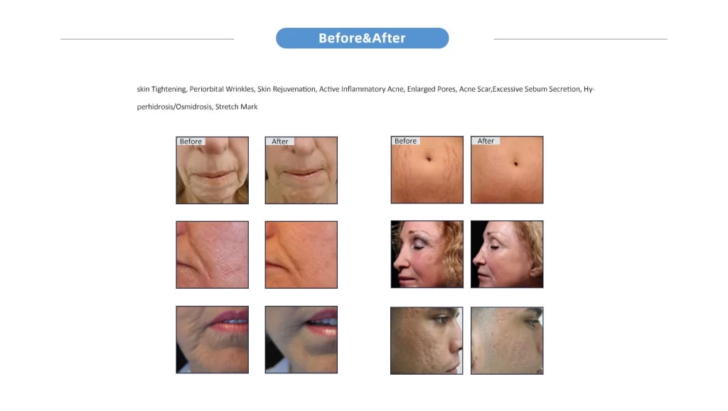NUBWAY | RF Microneedle: Targeted Solutions for Various Skin Concerns
