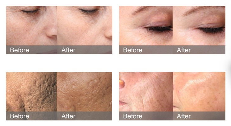 NUBWAY | Exploring the Multifunctional Capabilities of Nd:YAG Laser Systems