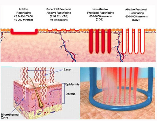 CO2 Laser Resurfacing: How Many Sessions? Results & Recovery Explained-1