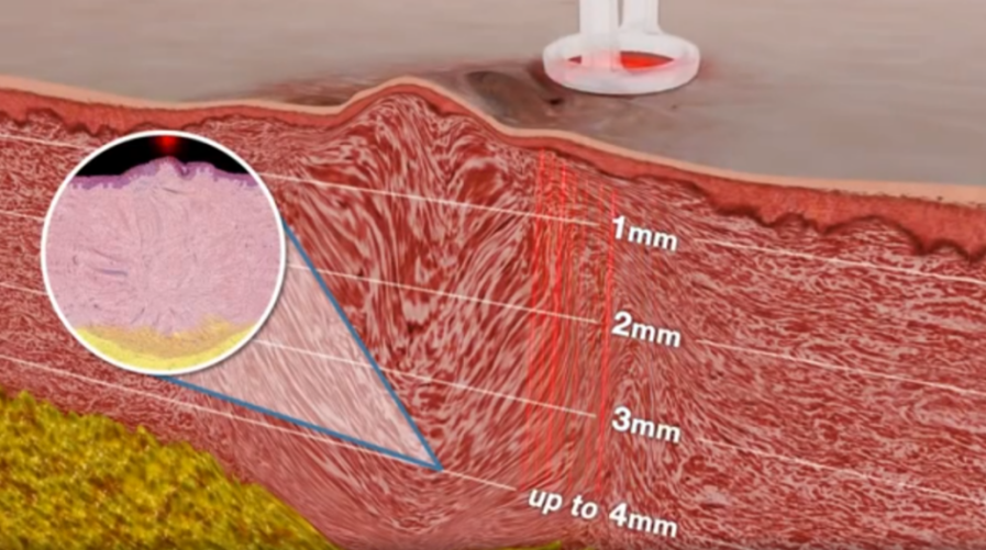 CO2 Laser Resurfacing: How Many Sessions? Results & Recovery Explained-2