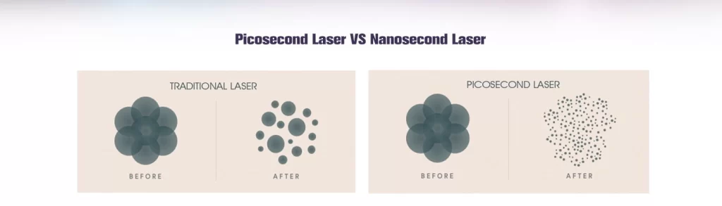 NUBWAY | Fractional Picosecond Laser Treatment Settings for Smoother Skin Results