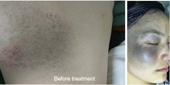 NUBWAY | Picosecond Laser: Is One Treatment Really Enough? Expert Insight
