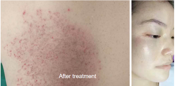 NUBWAY | Picosecond Laser: Is One Treatment Really Enough? Expert Insight