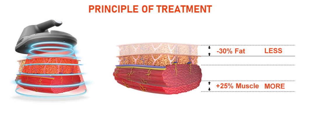 How Long Do Emsculpt Results Last? A Scientific Analysis & Long-Term Maintenance Guide-1