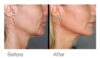 Unveil HIFU Treatment: How Many Sessions Will You Need to See Ideal Result-2