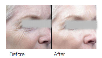 Unveil HIFU Treatment: How Many Sessions Will You Need to See Ideal Result-1