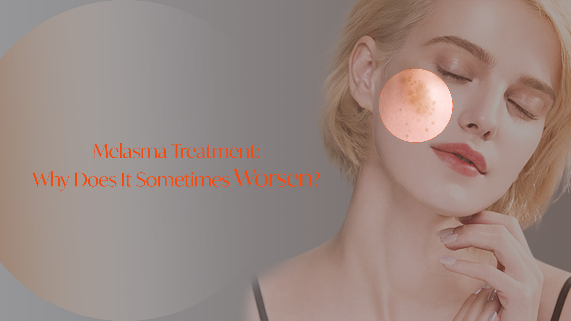 Melasma Treatment Why Does It Sometimes Worsen