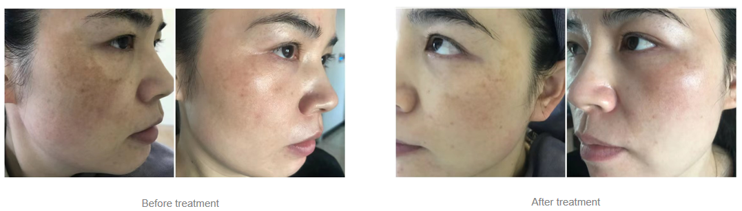 How to Combine Picosecond with Mesotherapy to Treat Melasma?-1