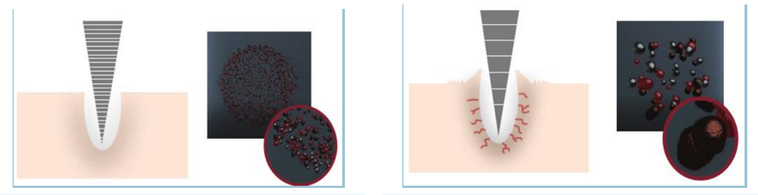 How to Combine Picosecond with Mesotherapy to Treat Melasma?-