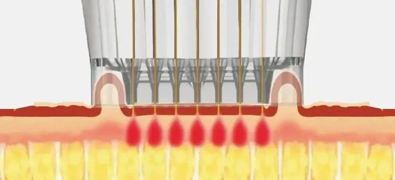 Comprehensive Guide to RF Microneedling Duration: Understanding the Science and Maximizing Results-1