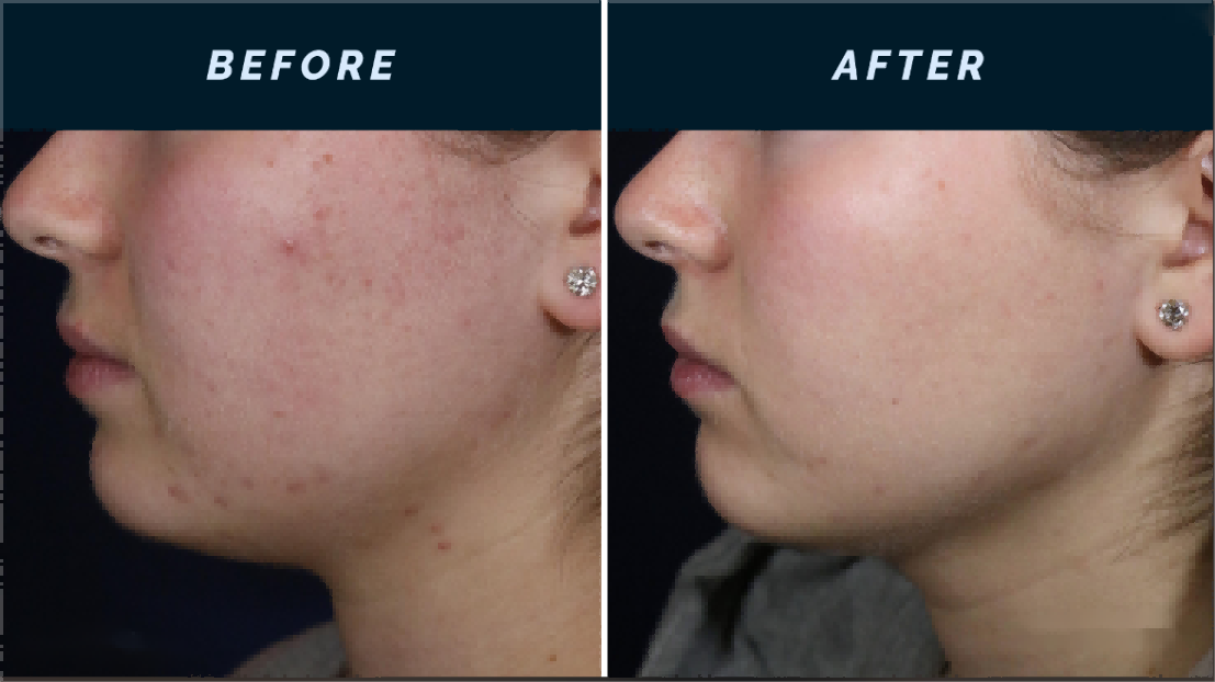 Comprehensive Guide to RF Microneedling Duration: Understanding the Science and Maximizing Results-2