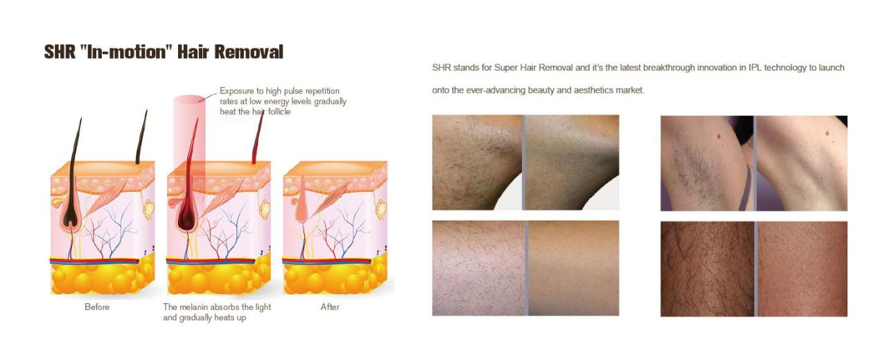 Evaluation of the Efficacy and Safety of IPL Hair Removal Technology-1
