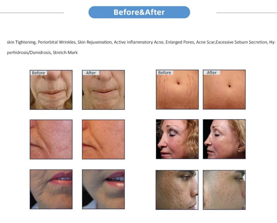 RF Microneedling Aftercare Checklist: What to Do, What to Avoid, and When-1