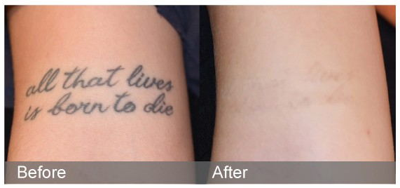Unveiling ND: YAG Laser: Can Your Eyebrow Tattoos Be Safely Removed?-2