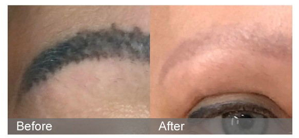 Unveiling ND: YAG Laser: Can Your Eyebrow Tattoos Be Safely Removed?-1