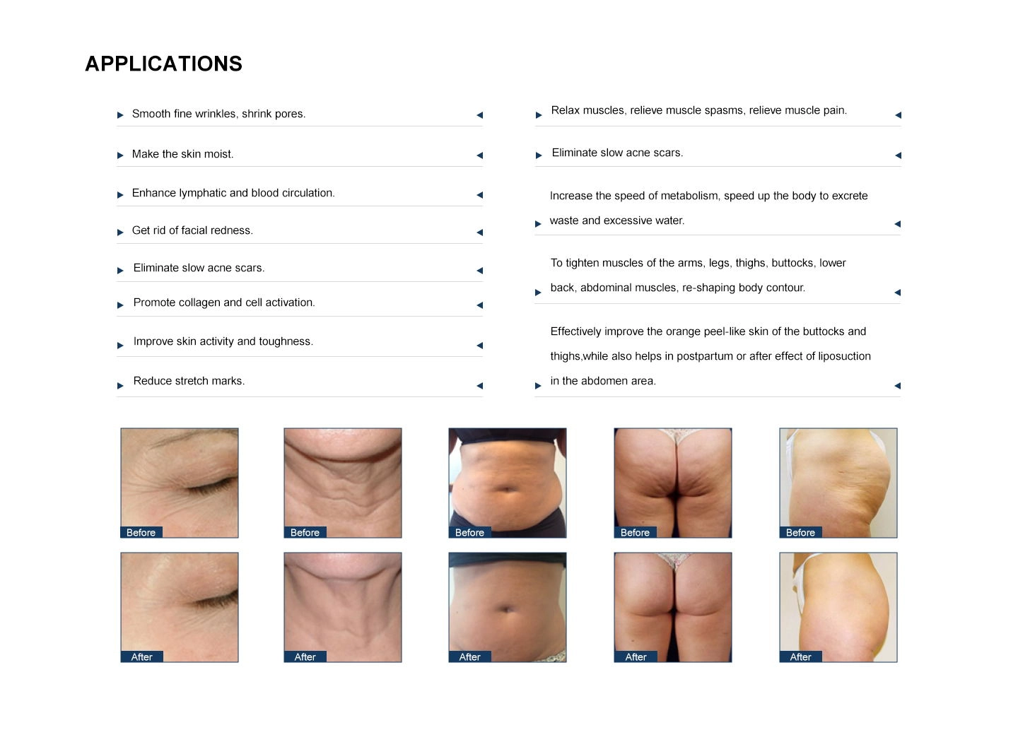 NUBWAY | Cavitation vs RF in One Machine: What Each Technology Does—and When to Combine NUBWAY | Cavitation vs RF in One Machine: What Each Technology Does—and When to Combine
