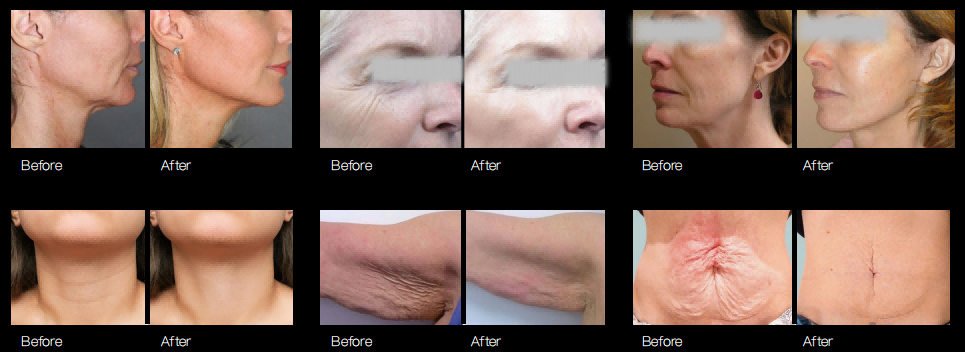 NUBWAY | MPT HIFU vs Traditional HIFU: Technological Upgrades for More Efficient and Comfortable Skin Beauty