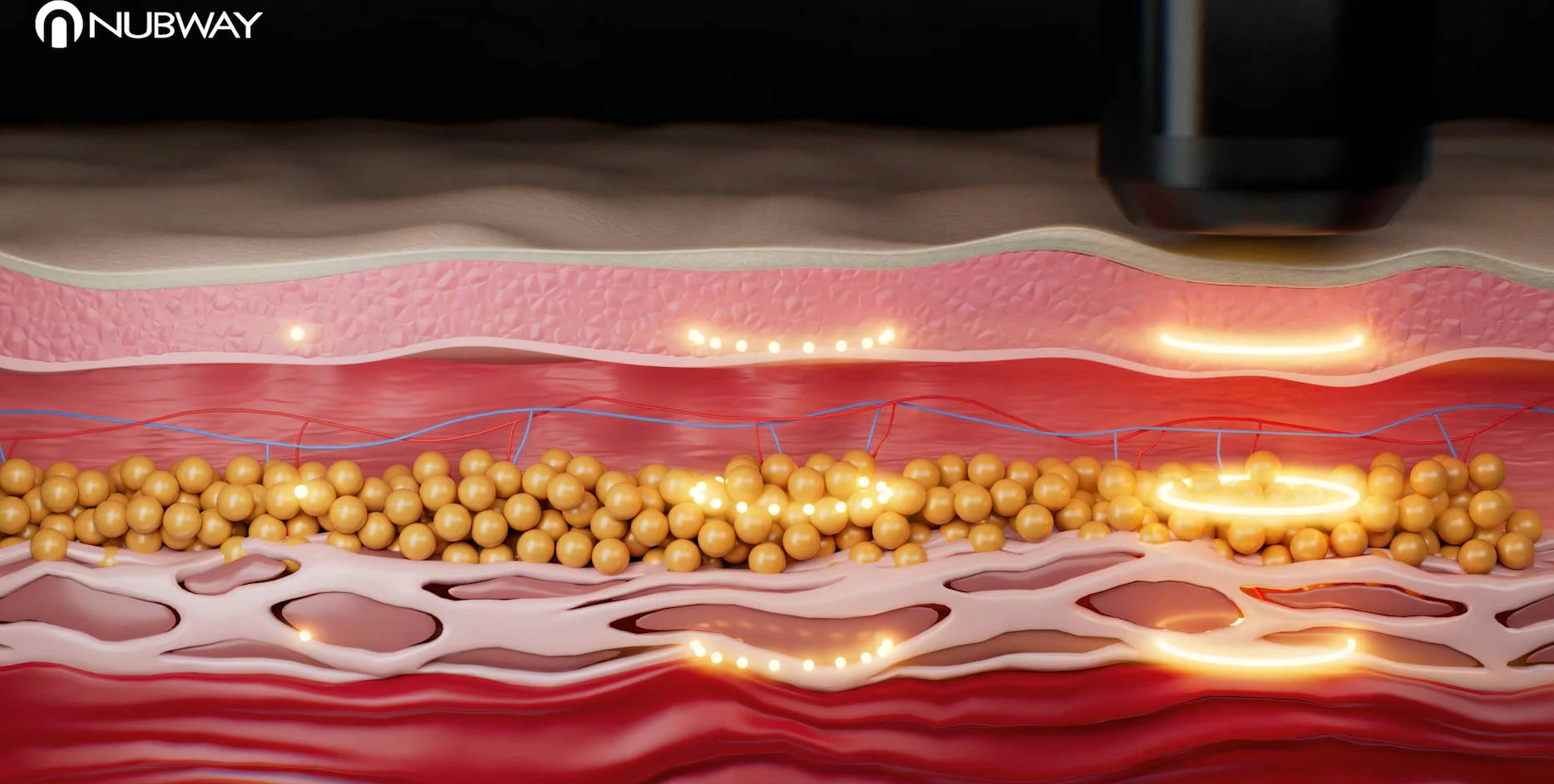 NUBWAY | HIFU Before and After: What 1 Week, 3 Months, and 6 Months Really Look Like