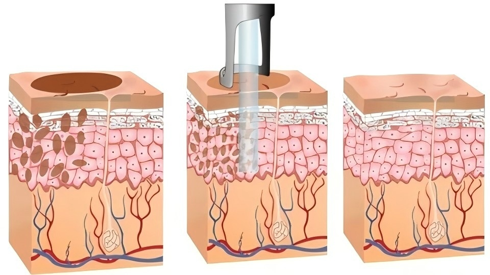 NUBWAY | How to Achieve the Optimal Endpoint Response for Laser Freckle Removal