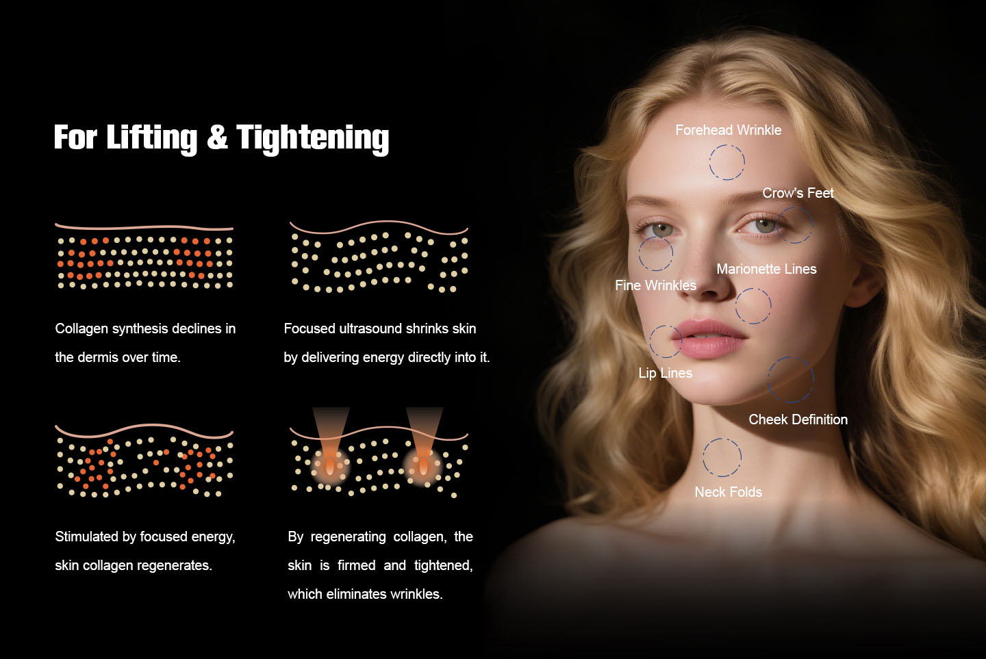 NUBWAY | HIFU（MPT）Machine