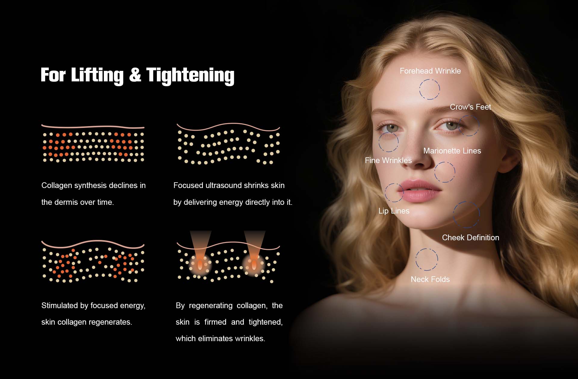 NUBWAY | HIFU(MPT)Machine NUBWAY | HIFU(MPT)Machine