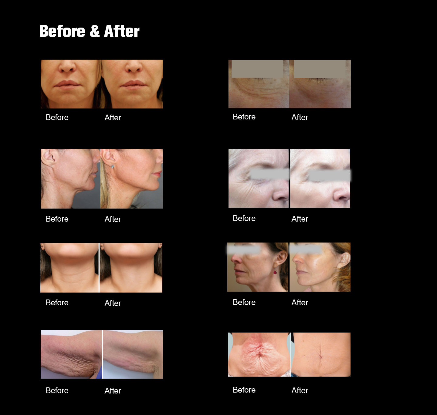 NUBWAY | HIFU（MPT）Machine