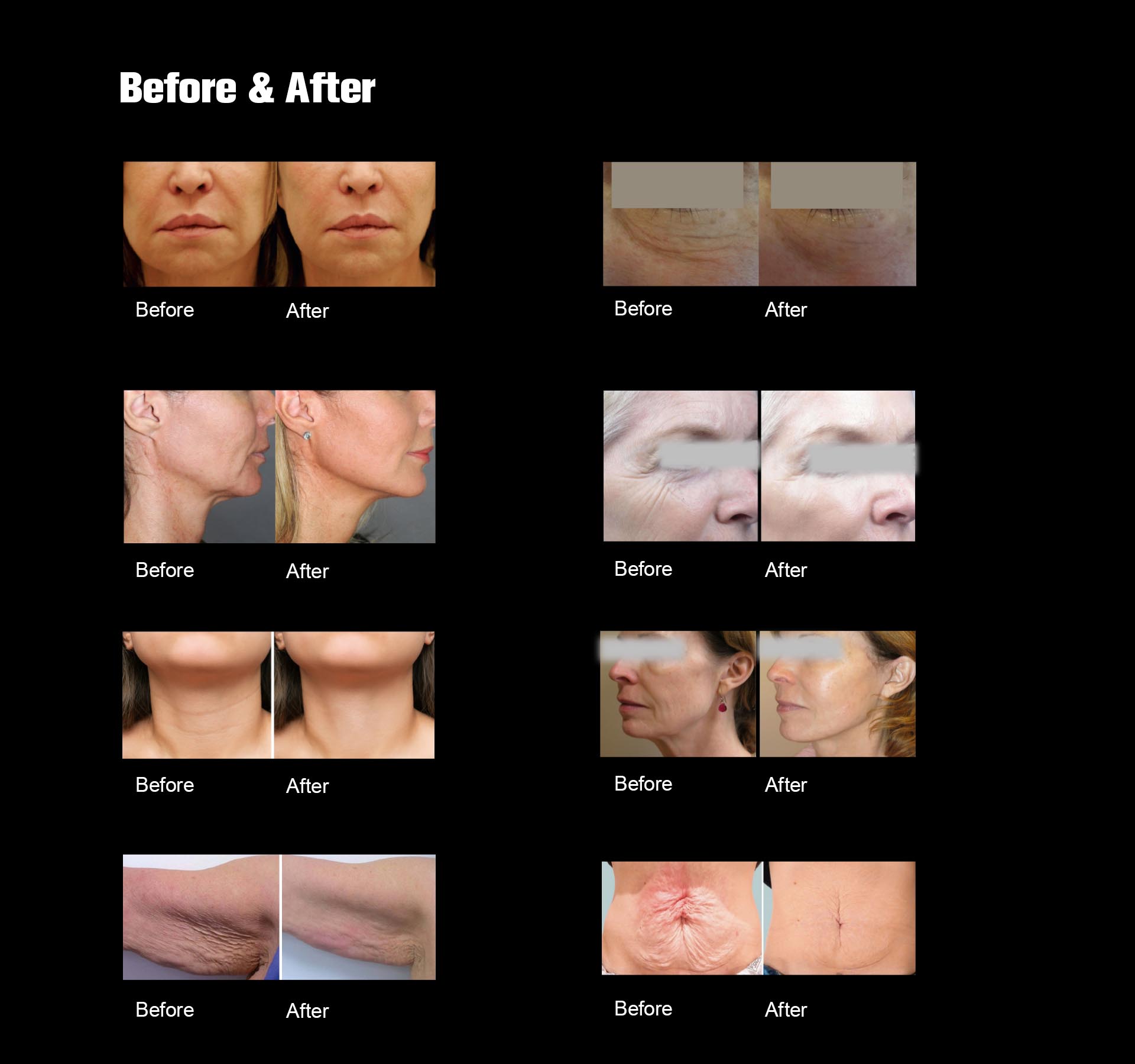 NUBWAY | HIFU(MPT)Machine NUBWAY | HIFU(MPT)Machine