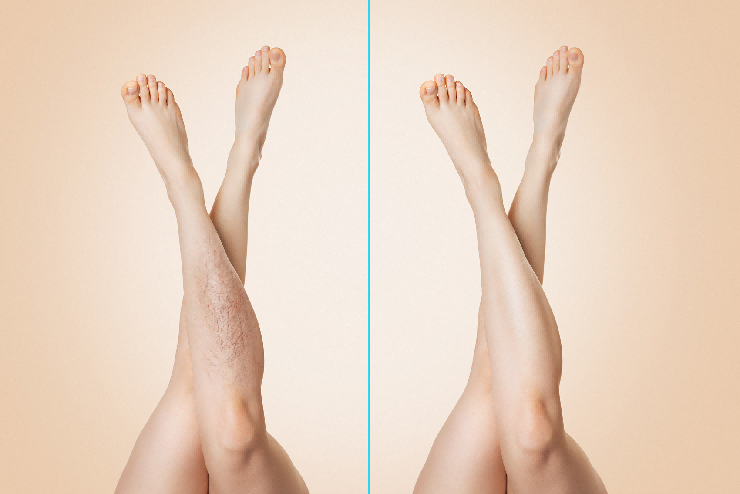 NUBWAY | Want to Try Laser Hair Removal? Read This Complete Guide to Price and Results NUBWAY | Want to Try Laser Hair Removal? Read This Complete Guide to Price and Results