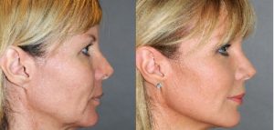 NUBWAY | Turn Back Time on Your Skin: The Secret to a Youthful V-Shape with HIFU