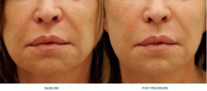 NUBWAY | Turn Back Time on Your Skin: The Secret to a Youthful V-Shape with HIFU