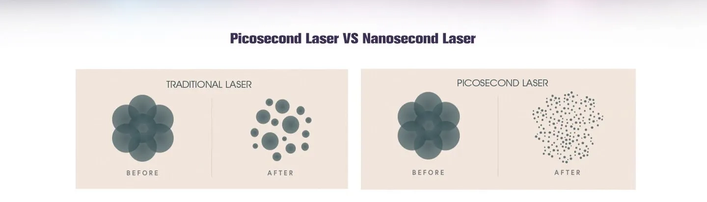 NUBWAY | Laser, IPL or Creams: Which Freckle Removal Method Lasts the Longest? NUBWAY | Laser, IPL or Creams: Which Freckle Removal Method Lasts the Longest?