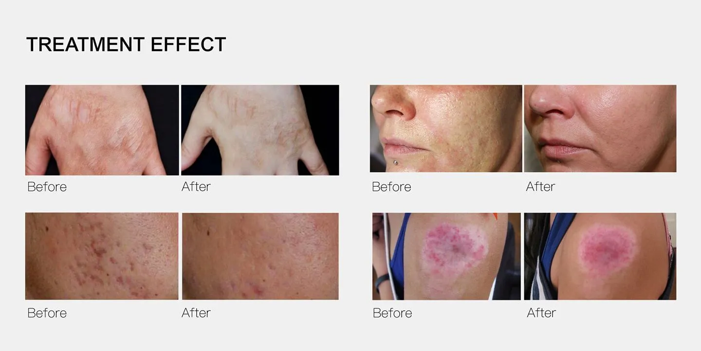 NUBWAY | RF Microneedling Machine vs Standard Microneedling Device: What Clinics Need to Know