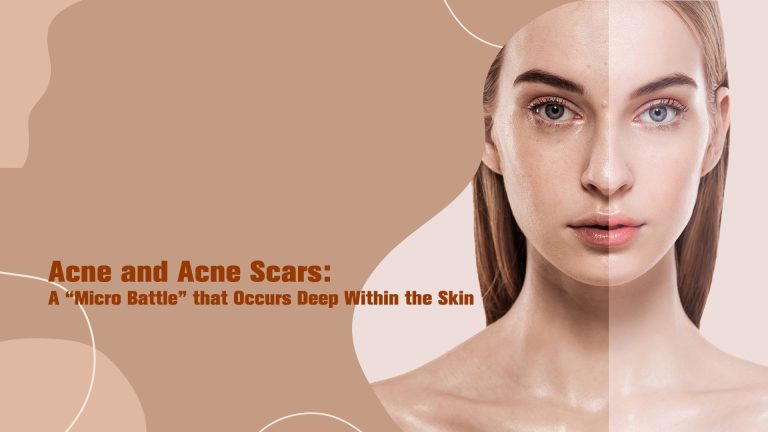 Acne and Acne Scars