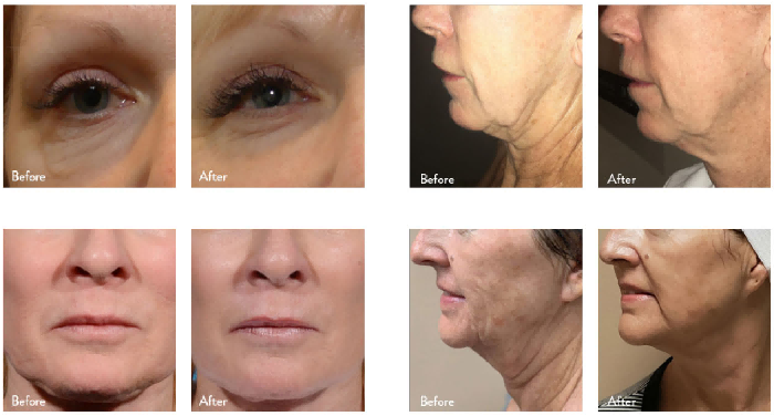 Is One Course of Inner Ball Roller Therapy Sufficient? Scientific Analysis of Therapeutic Efficacy and Continuous Care In depth-1 Is One Course of Inner Ball Roller Therapy Sufficient? Scientific Analysis of Therapeutic Efficacy and Continuous Care In depth-1