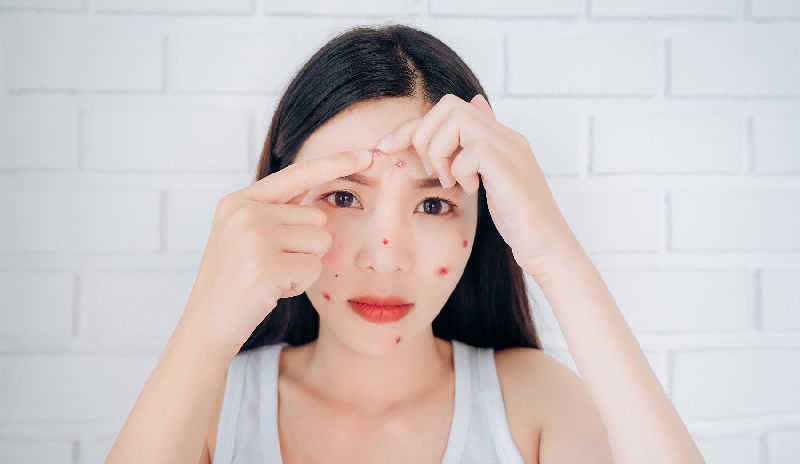 Acne and Acne Scars: A “Micro Battle” that Occurs Deep Within the Skin-