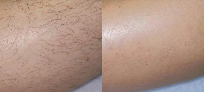 IPL Hair Removal Explained: Will Hair Return After Treatment Stops-1