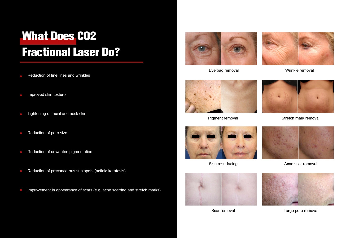 Fractional CO2 Laser Recovery Timeline: What Patients and Clinics Should Know-1 Fractional CO2 Laser Recovery Timeline: What Patients and Clinics Should Know-1