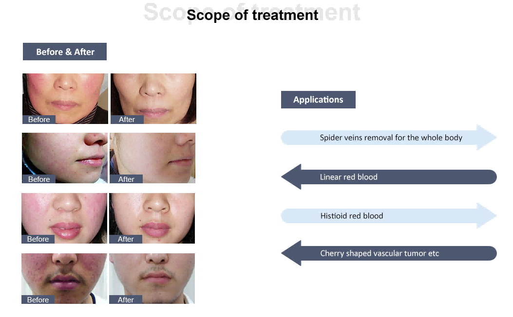 Do You Pay Attention to the Frequency of Use of Spider Vein Removal Machine? Scientific Operation to Avoid the Risk of Aggravation of Sensitive Skin-1