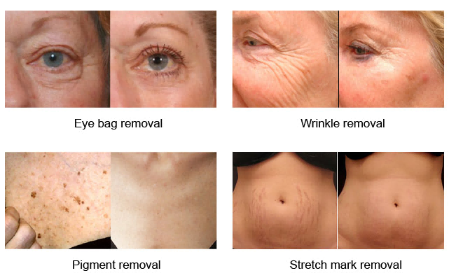 Removing Tattoo with No Scars Left: How Picolaser Smash the Stubborn Tattoos?-1