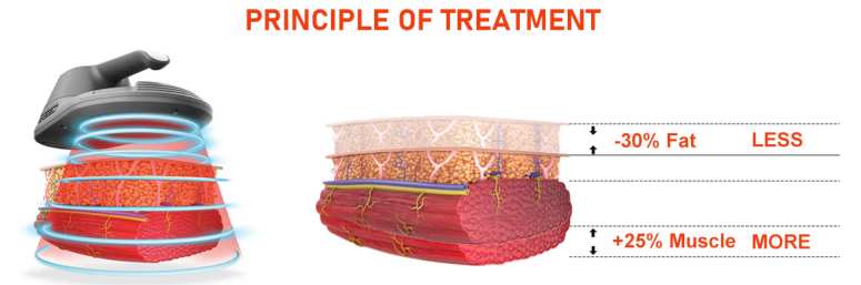 Ems+Rf Body Sculpting Device: Revolutionizing Non-Invasive Shaping Experience-1 Ems+Rf Body Sculpting Device: Revolutionizing Non-Invasive Shaping Experience-1