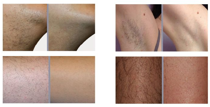 Light Output Frequency, Wavelength Range, And Cooling Technology: Three Core Indicators To Consider When Choosing An IPL Device-1