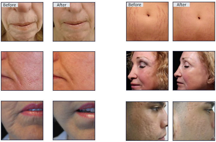 RF Microneedling Technology: Can Wrinkles Be Permanently Removed? Unveiling the Mystery of Youthfulness-1