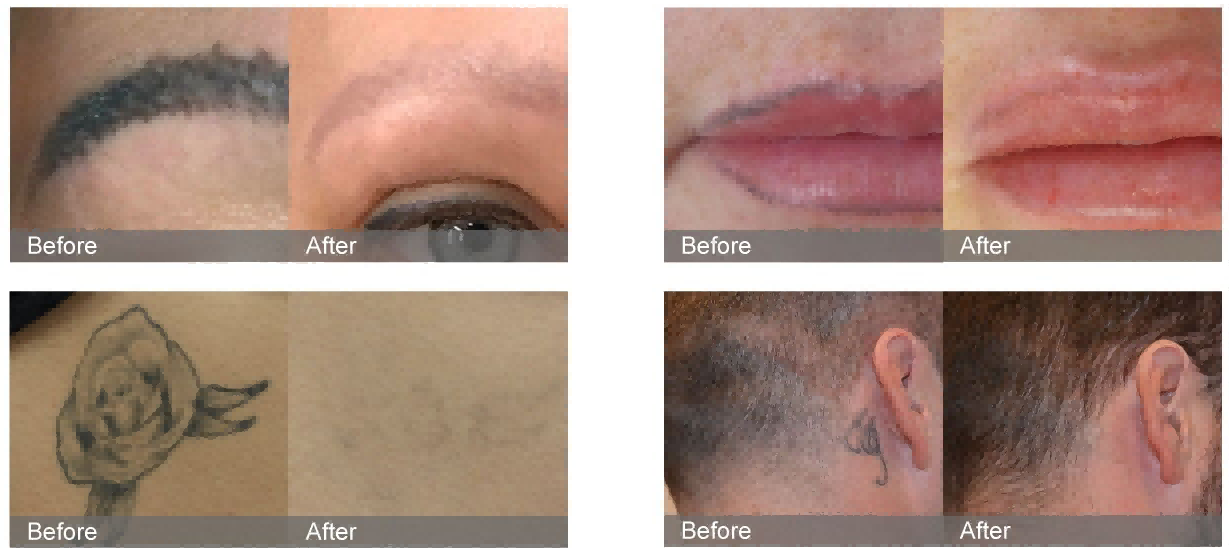 ND YAG Laser Tattoo Removal Full Analysis: Will It Harm Hair Follicles? Can Eyebrows Still Grow Out?-1 ND YAG Laser Tattoo Removal Full Analysis: Will It Harm Hair Follicles? Can Eyebrows Still Grow Out?-1