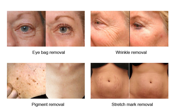 Your Face Looks Brighter? Revealing The Underlying Logic of Co2 Machine to Improve Redness and Dullness-1