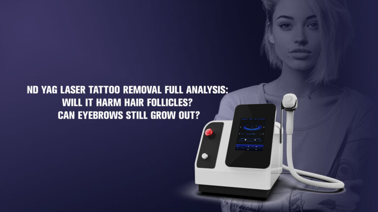 ND YAG Laser Tattoo Removal Full Analysis