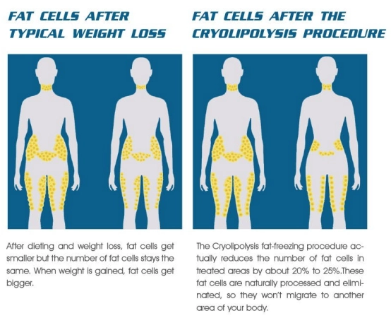 Analyzing the Profit Potential of Cryolipolysis Machines for Clinics-1