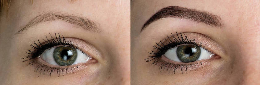 Eyebrow Tattoo Removal Process: Treatment Steps, Sessions, Healing, and Expected Results-1 Eyebrow Tattoo Removal Process: Treatment Steps, Sessions, Healing, and Expected Results-1