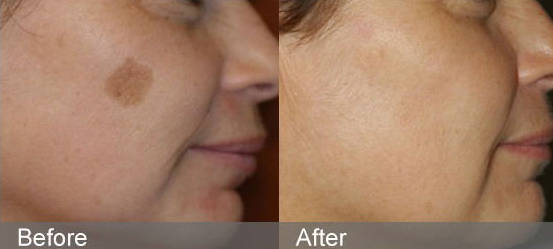 Picosecond Laser vs. Q-Switched Laser: Which Is Better for Tattoos and Pigmentation?-1 Picosecond Laser vs. Q-Switched Laser: Which Is Better for Tattoos and Pigmentation?-1