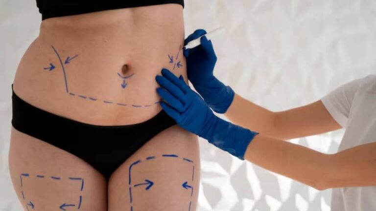 Does Cryolipolysis Treatment Really Work 7 Things to Know Before Fat Freezing